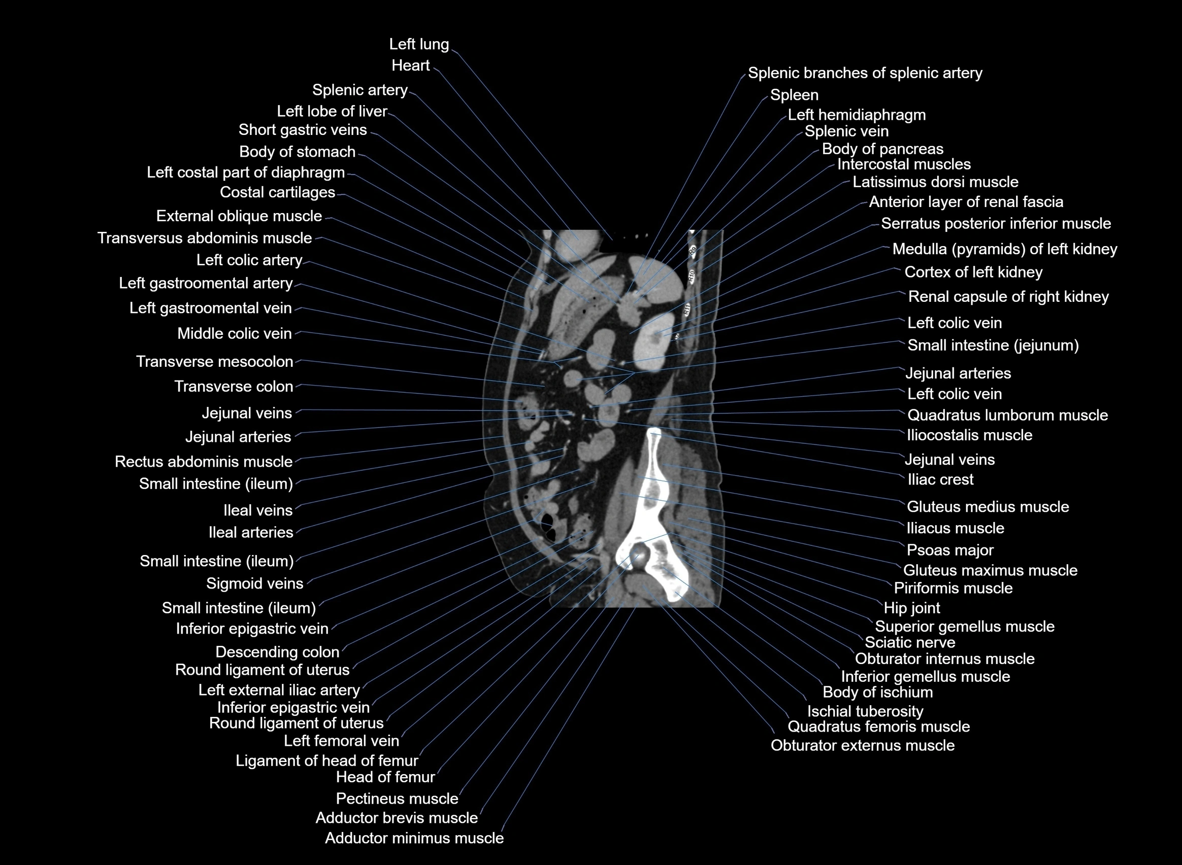 CT Abdomen sagittal cross sectional anatomy labelled radiology image -00035.webp